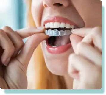 Clear Aligners vaughan