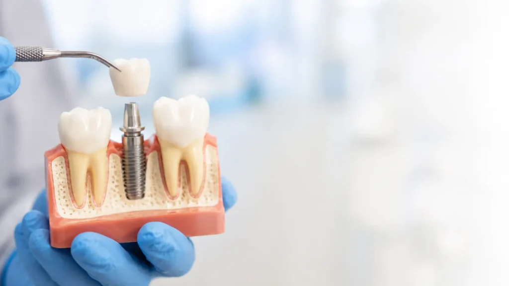 dental implants vaughan