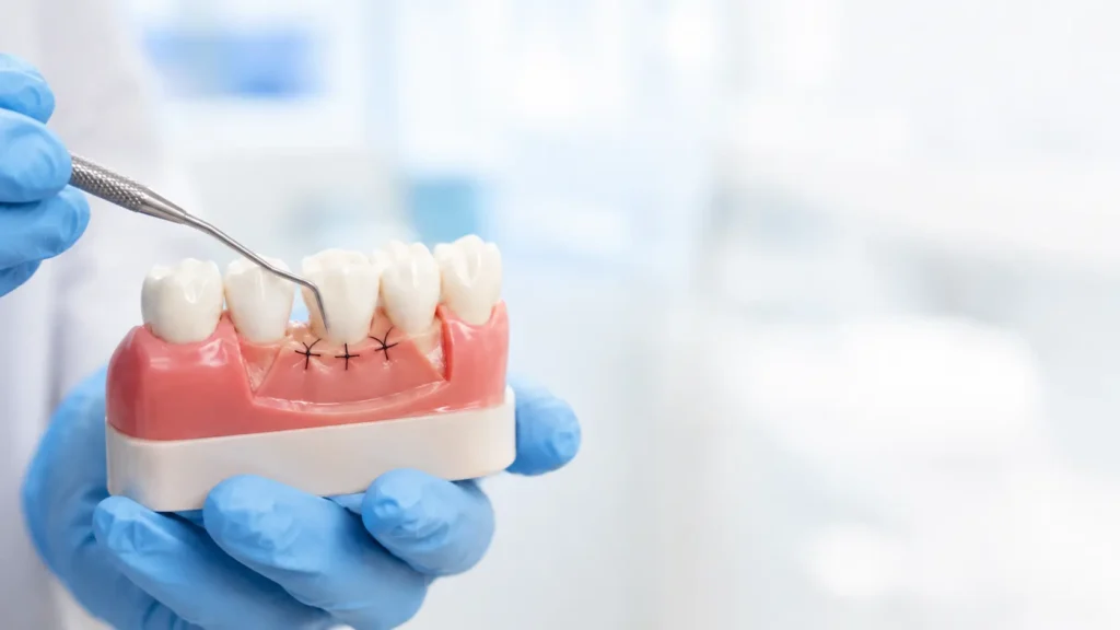 Gum Disease