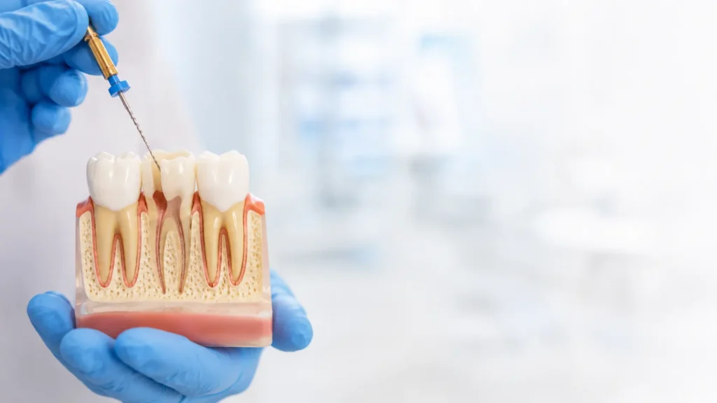 root-canal-therapy vaughan